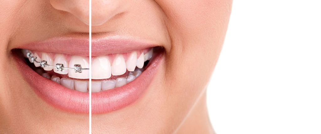 Konya Diş Teli Fiyatları 2021 - Konya Diş Teli Tedavisi