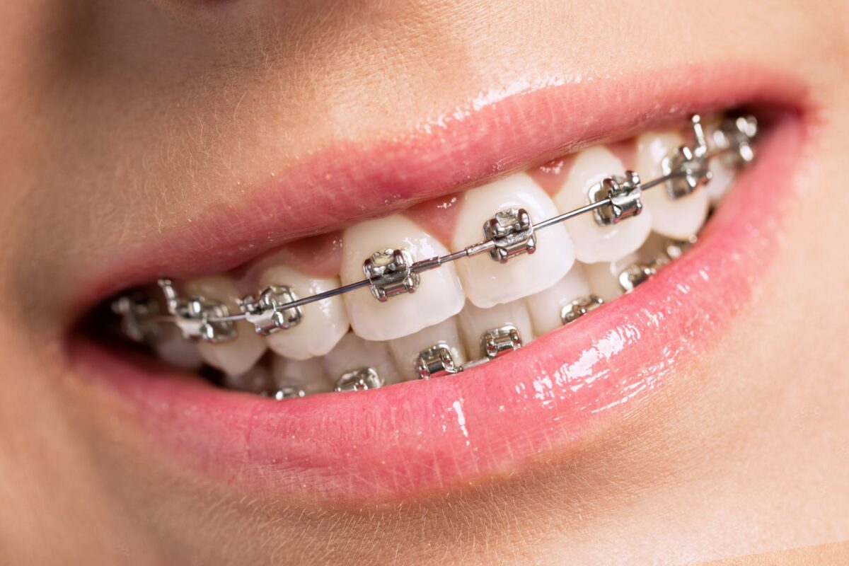 Ortodonti Tedavisi Gerekli midir?