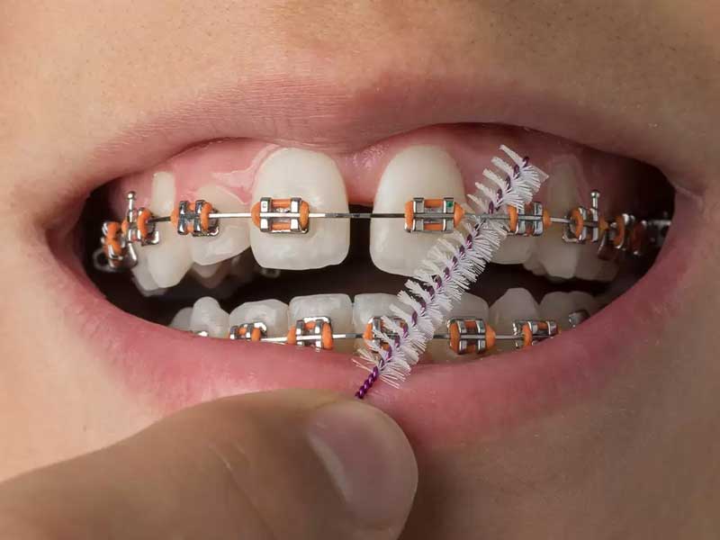 Karaman Diş Teli Tedavisi - 2025